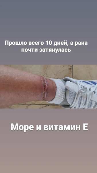 Травмы Олега Тактарова постепенно заживают Травмы Олега Тактарова постепенно заживают