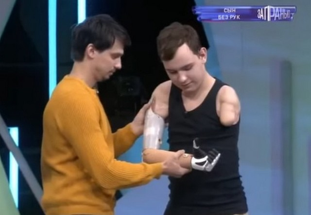 В студии НТВ Денис примерил бионический протез