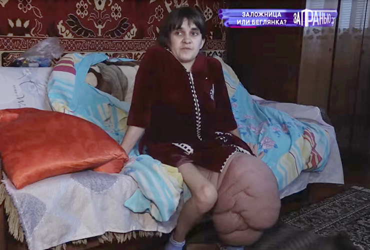 Людмила живет с такой ногой уже 17 лет