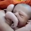 В Индии родился ребенок с четырьмя руками и ногами