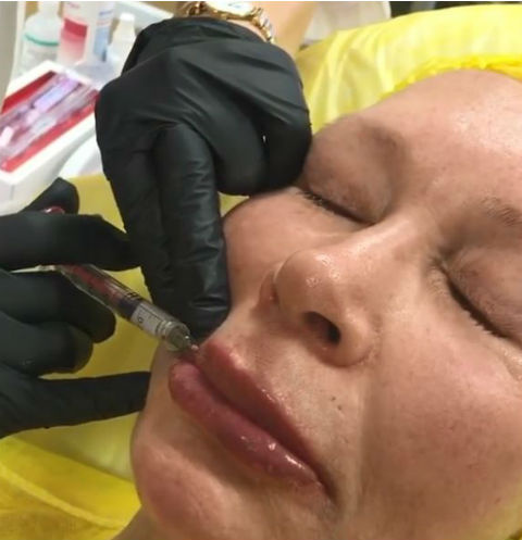 Косметолог провел артистке контурную пластику губ