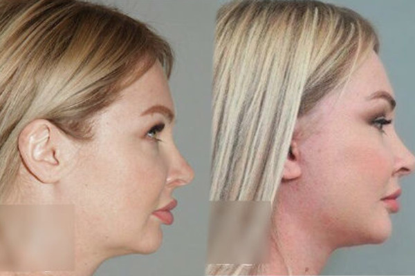 Пластический хирург показал фото Дарьи Пынзарь до и после операции